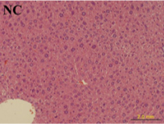 Liver lesion