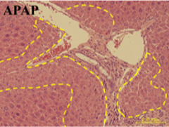 Liver lesion