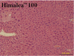 Liver lesion