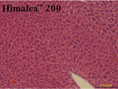 Liver lesion
